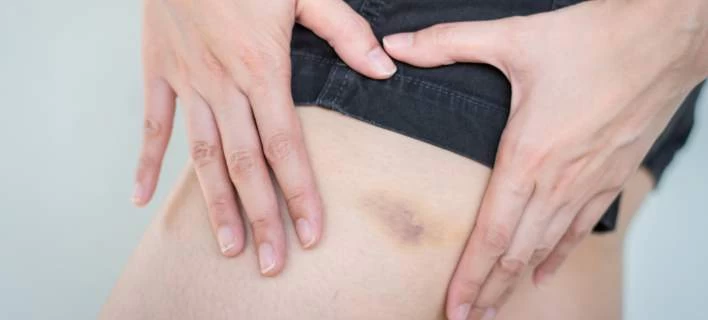 Μώλωπες: Τι συμβαίνει όταν εμφανίζονται χωρίς προφανή αιτία